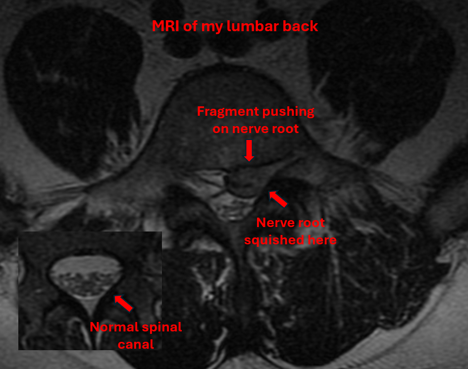 Axial MRI scan of lumbar spine showing spinal canal stenosis. The main image displays a cross-sectional view with annotations pointing to a disc fragment compressing a nerve root and the location where the nerve root is being compressed. An inset image in the lower left shows a comparison view of a normal spinal canal for reference.